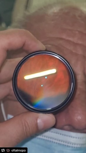 Dr. Stefano Russo on Instagram: "Ozurdex™️ Implant #🥢 👁️ Dexamethasone Intravitreal Implant 0.7 mg (Ozurdex, Allergan®) is a biodegradable corticosteroid intravitreal implant that has been approved by the FDA for treatment of diabetic macular edema (DME), macular edema following a branch retinal vein occlusion (BRVO) or central retinal vein occlusion (CRVO), and posterior segment non-infectious uveitis. Dexamethasone is a corticosteroid, which is a class of anti-inflammatory medications. Becau