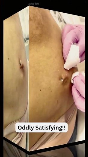Large Blackheads Extraction Big Cystic Acne Blackheads&Whiteheads Removal Pimple Popping #1081 2026