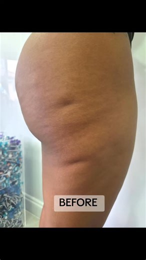 Dr Minoka Nadesan on Instagram: "Visible skin dimpling through clothing is most commonly caused by cellulite-related fibrous adhesion bands tethering the dermis to deeper tissue layers. These bands create uneven tension, resulting in the characteristic dimpled appearance. DrMinx offers an advanced collagen-stimulating treatment designed to: Disrupt and release fibrous adhesion bands Stimulate neocollagenesis and dermal thickening Improve skin strength, elasticity, and surface smoothness By targe