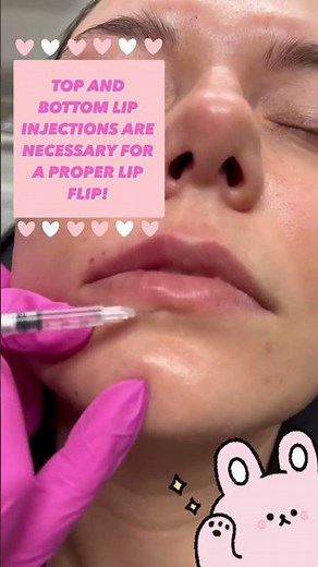 Top and Bottom Lip Injections are NECESSARY for a Proper Lip Flip!