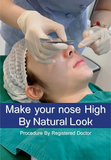 Non-Surgical Nose Lift: 6 Years Experience with PCL PLLA Threads