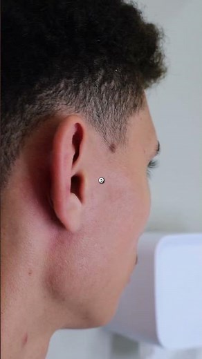 OTOPLASTIA: Em quanto tempo a cicatrização some?