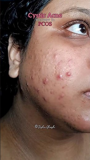 Cystic Acne Recovery in PCOS | Acne Treatment & Cure | PCOS PCOD Breakouts | Purging | Disha Ghosh