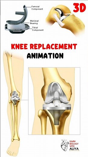 knee replacement animation #medical #animation #3d #short | learn Biology with Aliya