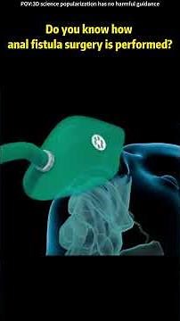 Fistula Surgery (Seton Replacement) Medical Animation 3D #analfistula #medicalanimation