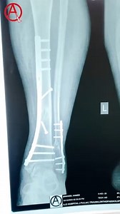 The Polio virus affects those individuals who for any reason don't get vaccination. Infected individuals can end up with irreversible paralysis and have difficulty living a normal life. This patient is a living example of such neglect, he sustained a complex fracture of his leg with was anatomically reduced and primary bony union was achieved. FOR APPOINTMENT CALL! AO HOSPITAL Karachi (NAZIMABAD) 0333 5222510 AO CLINIC -Karachi (DHA/CLIFTON) 03320233017 National Hospital (DHA ) Lahore 0333 52225