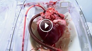 Bijúce ľudské srdce v zariadení TransMedics OCS