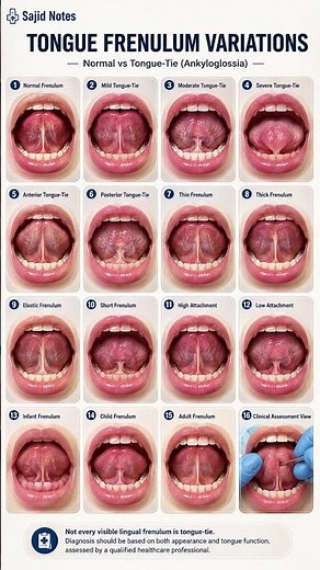 Tongue Frenulum Variations | Normal vs Tongue-Tie (Ankyloglossia) Explained 👅Hashtags: #TongueTie