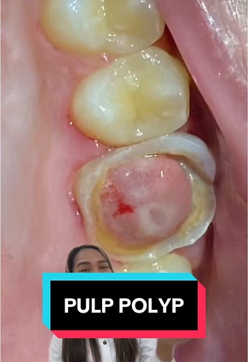 Pulp Polyp: Understanding Symptoms and Treatments