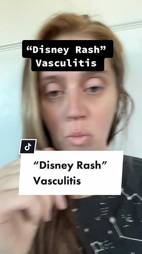 Understanding Vasculitis: What You Need to Know about Disney Rash