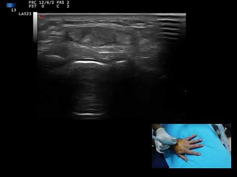 Ultrasound guided wrist extensor tenosynovitis injection, by Prof Murat Karkucak MD