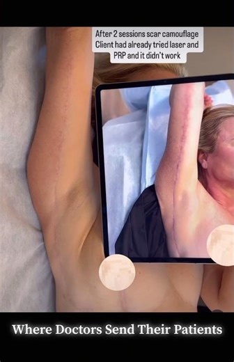 ✨ Arm Lift Scar Transformation | When Other Treatments Failed