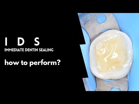 Immediate Dentin sealing | How to perform | Full protocol