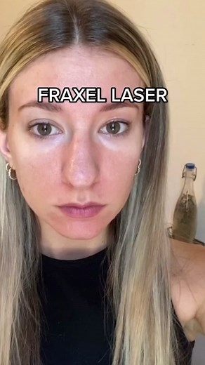 Fraxel Laser Skin Resurfacing: My Journey from Before to After