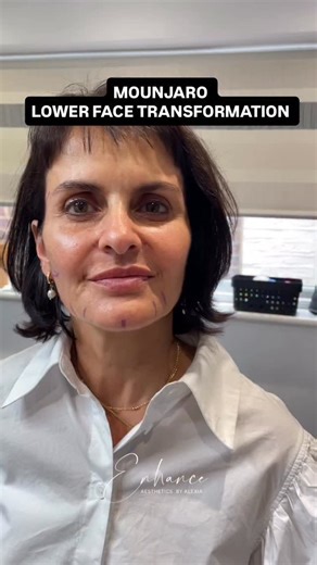 Alexia Louisa on Instagram: "Starting your weight loss journey can be exciting-but don’t let it age your face in the process! Mounjaro face happens when rapid weight loss leads to volume loss in the face. Luckily, we can prevent and treat it with these following steps: 🤍Step 1: Rebuild volume in the mid-cheek to restore that youthful contour. 🤍Step 2: Replace fat loss in the cheekbone and buccal space for a balanced, natural look. 🤍Step 3: Use collagen stimulators like Profhilo, profhilo stru