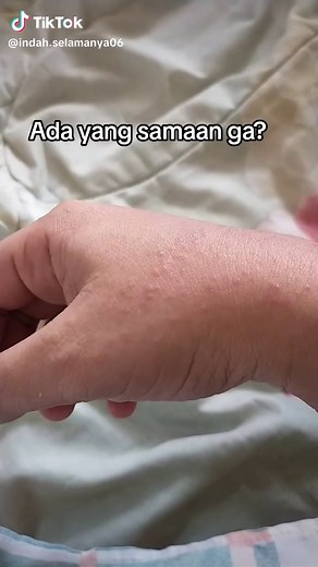 Penyebab dan Cara Mengatasi Gatal Pada Tangan: Tips Efektif 2024