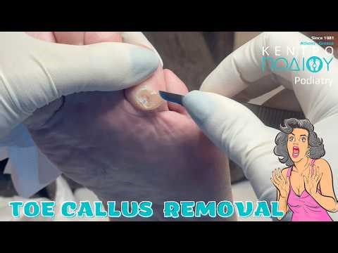 Toe Callus RemovalΑφαίρεση κάλου δακτύλου #kentropodiou #κεντροποδιου #podologos #podiatry #ποδολόγο