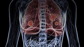 Immunotherapy: Changing Patient Outcomes in SCLC