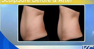 SculpSure non-surgical body contouring