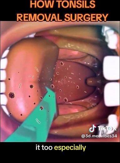 How Tonsil Removal Surgery Works
