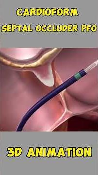 Cardioform Septal Occluder (PFO) Explained in 3D – Closing the Heart’s Hole Safely