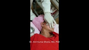 3.9K views · 22 reactions | The midface lift is used to correct the effects of gravity and aging.It is the most effective treatment for deep smile line, saggy and lax skin. New baneshwor, Kathmandu 01-4780110/ 98-0108-0462 Korean Aesthetic Let Mein. | Let Me in | Facebook