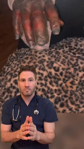 Frostbite to the fingers. #frostbite #frostbittenkiss #wintertime #emergencymedicine #erdoctor #doctor #constipation #fiber #nutrition #medical #growthmindset #ambulance #emergency #healthcare #doctorreact #residency #Psychologist #skincare #health #healthy #medicine #cancer #chiropractic #pimplepopper | Doctor Joe