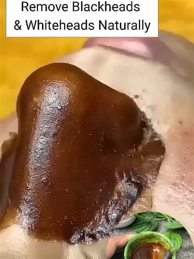 Effective Blackhead Removal Tips for Clear Skin