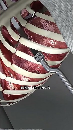 Pectus Excavatum And Nuss Procedure (3D Animation) #surgicalvisualization #medicalprocedure