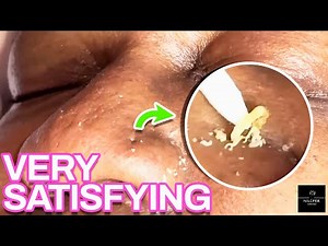 Most Satisfying Extractions | MUST WATCH | NILUFER ESTHETICS SPA 🤍