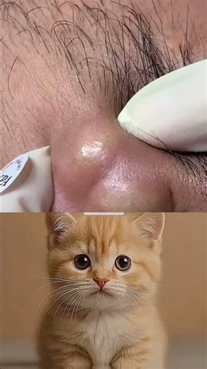 Removing large blackheads and pimples from face new 2026 #02