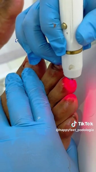 Tratamiento Efectivo para Hongos en Uñas en Lima