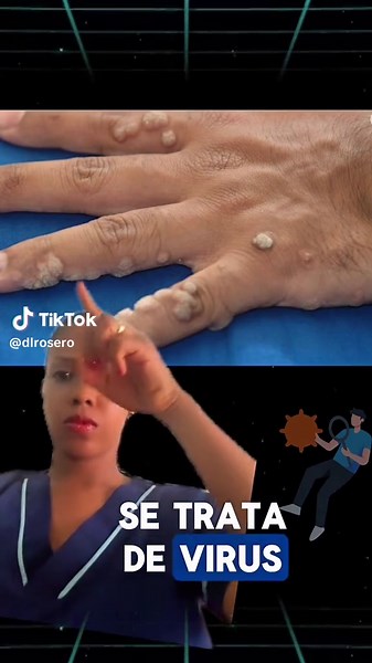 Verrugas en las manos: causas y tratamientos efectivos