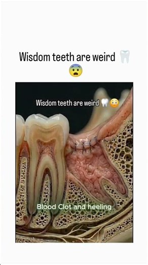 Wisdom teeth extraction at Aesthetica Dental Clinic Punawale. #aesthetica #dental #dentist