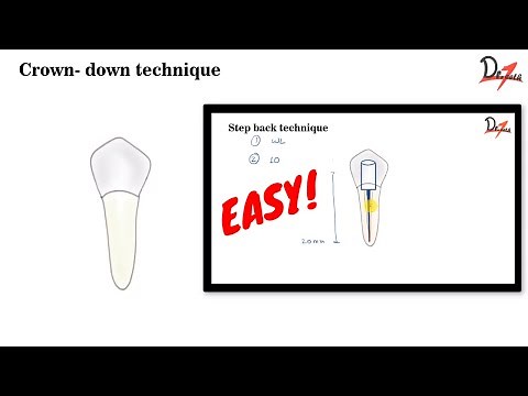 Crown- down Technique| ENDODONTICS |