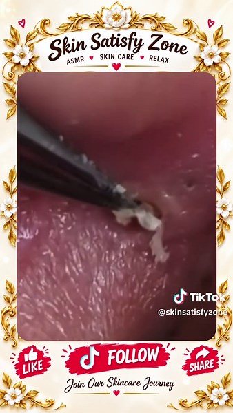Deep Blackhead Extraction & Satisfying Popping | Wait for the most satisfying pop 😳🫣 You won’t believe what comes out! #pimplepoppersatisfying #Acne #pimple #Blackhead #Satisfying
