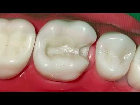 Indirect wax pattern fabrication