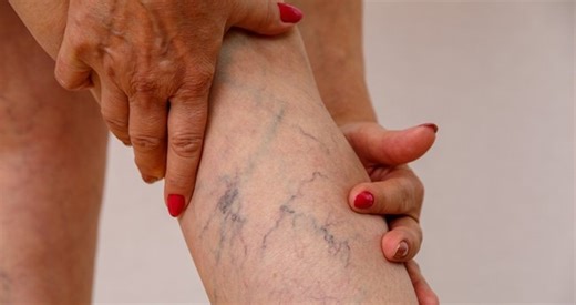 Varis Ağrısına Ne İyi Gelir? Evde Doğal Yöntemlerle Varis Ağrısı Nasıl Geçer?