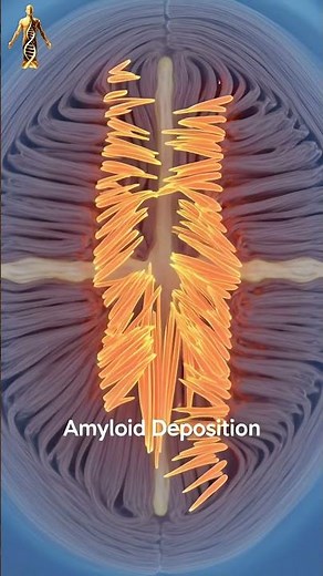 ATTR-CM Explained in 3D | Transthyretin Amyloid Cardiomyopathy#biodigitalbody