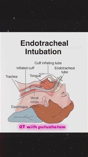 Indotracheal Intubation #anaesthesiology #medicalstudent #nurse
