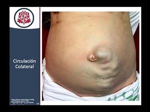 Cirrosis - Presentación Clínica