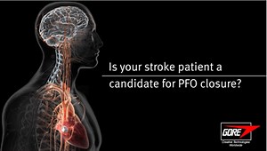 Is your stroke patient a candidate for PFO closure?