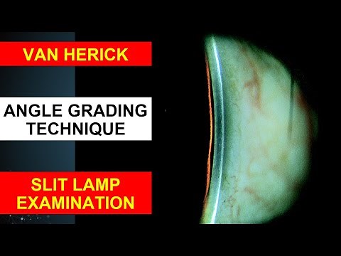 Van Herick Slit Lamp Technique | Angle Grading Technique | Anterior Chamber Angle Test