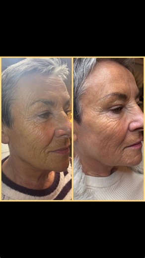 ✨ Before & After – Radiesse® Hyperdilute ✨ A huge thank you to...