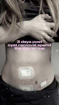 Follow along for more on my recovery and surgery experience 💓#laparoscopy #pcos #endometriosis