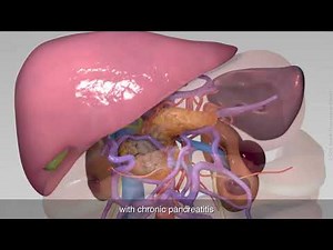 Total pancreatectomy with splenectomy, right hemicolectomy and reconstruction of portal vein