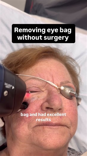 rahul shukla md, frcpc on Instagram: "Removing eye bags without surgery 👀✨ • Surgery remains the gold standard to remove true under-eye “bags” • If surgery fails — or you prefer a non-surgical option — fractional #CO2 laser can be an excellent choice in select cases • Our patient underwent two surgeries for a stubborn right eye bag (aka a festoon) without success and wanted another option • After one session of fractional #CO2 laser with customized settings, a significant reduction in the eyeba