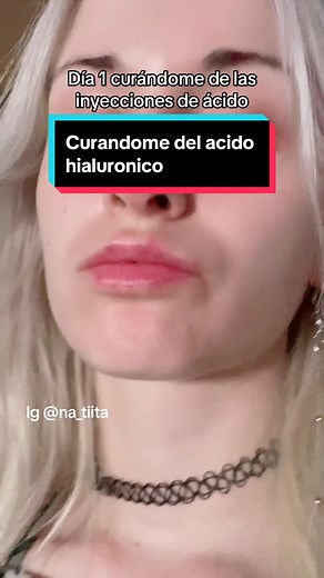 Video informativo ✨ #acidohialuronico #inyecciondelabios #rinomodelacion