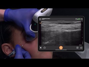 Tear Trough Filler Placement