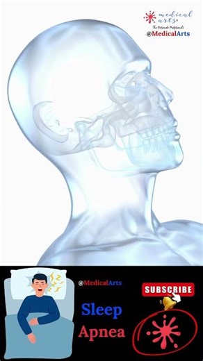 Snoring 💤 Obstructive Sleep Apnea 😴